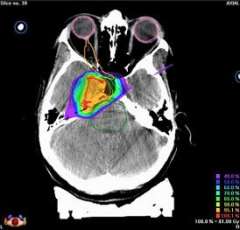 CT image showing pear-shaped tumor