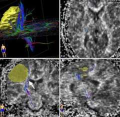 Diffusion Tensor Imaging (DTI)
