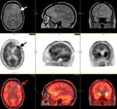 MRI scans showing a small low-grade astrocytoma