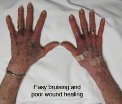 Woman hands showing bruising