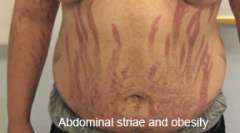 Abdominal striae on stomach