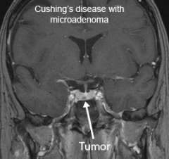 MRI of cushing's disease