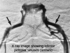 X-ray of Inferior Petrosal Sinus Sampling