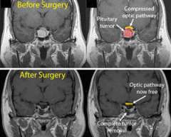 MRI collage of before and after Pituitary surgery