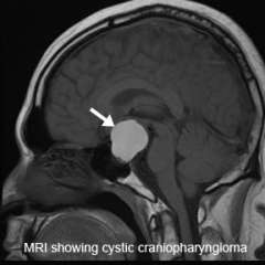MRI of Craniopharyngiomas 