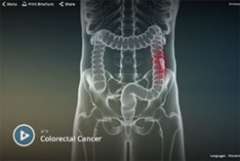 Colon Cancer