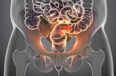 3D Model of colon afflicted with cancer