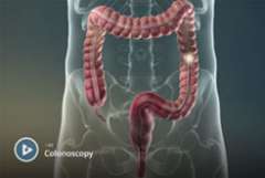 Colonoscopy