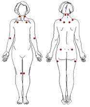 Body diagram of Fibromyalgia