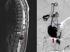 CT scan of Type IV Pial Spinal Arteriovenous Fistula