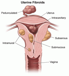 fibroids illustration