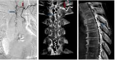 CT scan of Type I Spinal Dural Arteriovenous Fistula