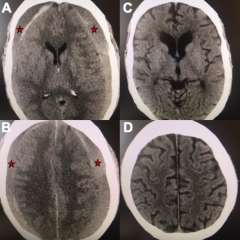 Axial views of a brain CT scan