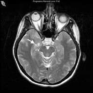 MRI showing Ganglioglioma