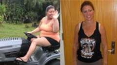 Jackie's Story - Weight Loss Surgery: Gastric Sleeve
