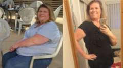 Judy's Story - Weight Loss Surgery: Gastric Sleeve