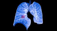 Lung Cancer Screening Image