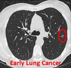 X-ray of early lung cancer