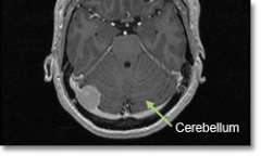 Meningioma Pfossa