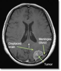 MRI of a meningioma tumor