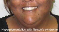 Hyperpigmentation on woman's face