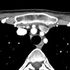 Axial 4D-CT image showing parathyroid adenoma