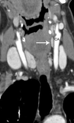 Coronal 4D-CT image of a parathyroid adenoma