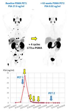 Example of a patient with metastatic castrate resistant prostate cancer responding to Lu177-PSMA radionuclide therapy