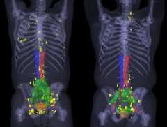This figure shows in yellow multiple prostate cancer lesions detected by PSMA PET/CT that are outside of the standard radiation fields