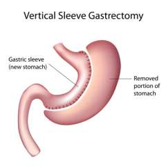 Sleeve Gastrectomy (VSG Surgery) Illustration