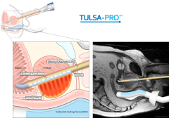 Pivotal Study of MRI-guided Transurethral US Ablation to Treat Localized Prostate Cancer