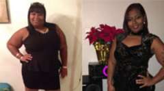 Therese's Story - Bariatric Surgery