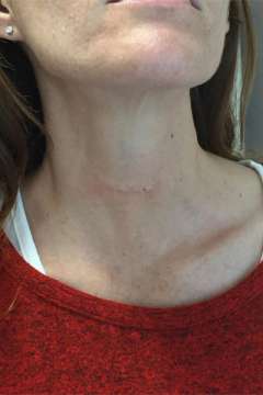 Scar after total thyroidectomy