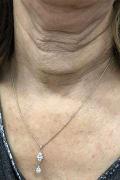 Scar after total thyroidectomy