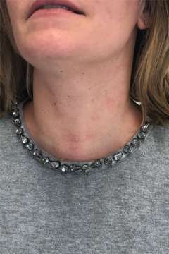 Scar after thyroid cancer surgery