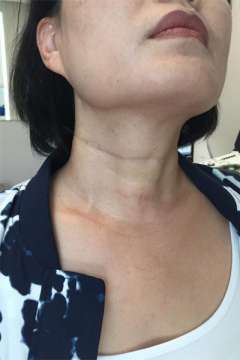 Scar after thyroid cancer surgery