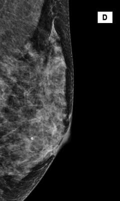 The breasts are extremely dense, which lowers the sensitivity on mammography.
