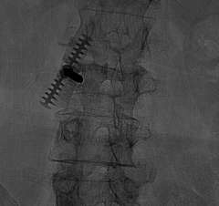 Figure 2. A needle is placed into the fractured vertebral body under x-ray guidance.