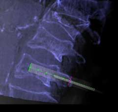 Figure 4. A needle is being placed into the vertebral body using the state-of-the-art 3-D navigation system, enabling very precise positioning of the needle without relying on classic bony landmarks that may become fuzzy in a patient with osteoporosis.