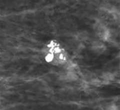 Coarse or popcorn-like calcifications
