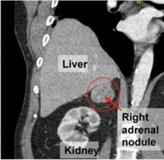 Adrenal tumor