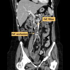 X-Ray diagram of IVC occlusion and filter