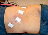 Laparoscopic Trans-abdominal Adrenalectomy