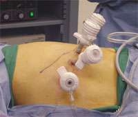 Laparoscopic Trans-abdominal Adrenalectomy