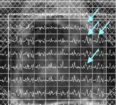 Spectroscopic imaging for Nerve Sparing