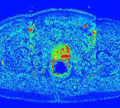 Example perfusion map