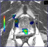 Prostate Perfusion Map