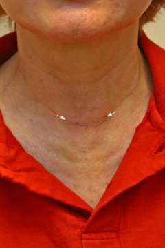 Scar after benign thyroid disease surgery