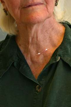 2 weeks after surgery