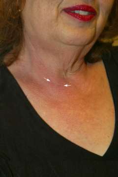 3 months after surgery.